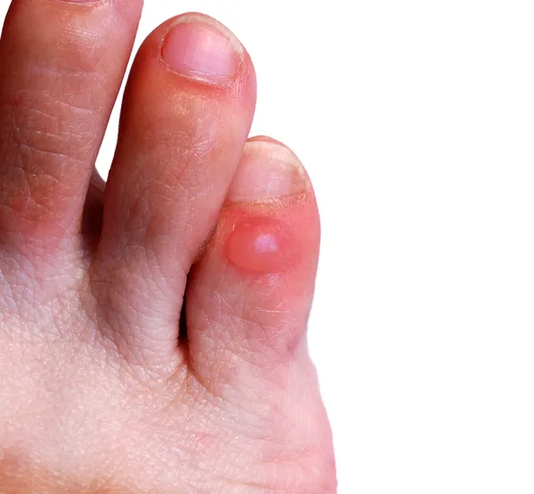 Blister on little toe — Stock Photo, Image