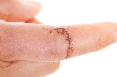 Close-up of sewed wound on caucasian finger clipart