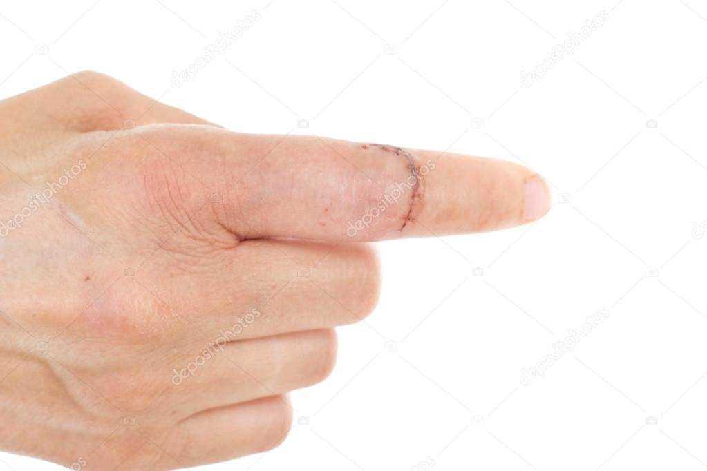 Caucasian finger with sewed wound
