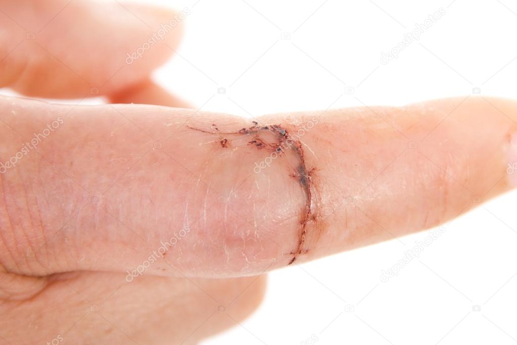 Close-up of sewed wound on caucasian finger