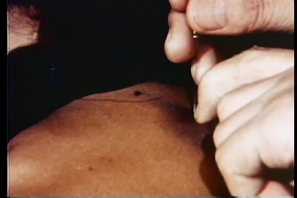 Close-up of hand sticking acupuncture needles in skin — Stock Video