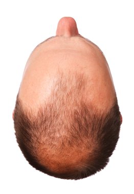 Male pattern baldness clipart