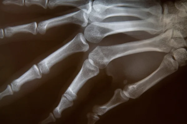 Radiographie de la main — Photo