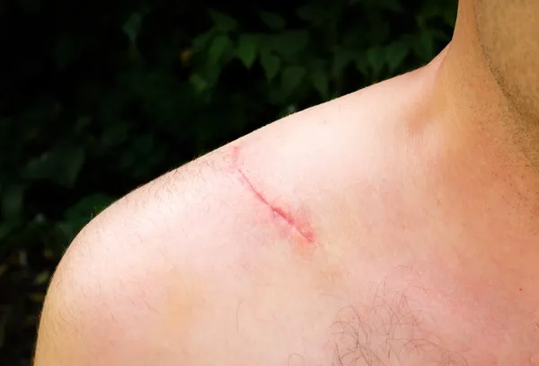 Scar on man — Stock Photo, Image