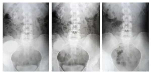 Raio-X dos quadris do corpo, análise da doença renal — Fotografia de Stock