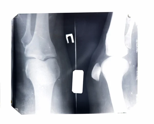 X-ray of the patella in 2 positions — Stock Photo, Image