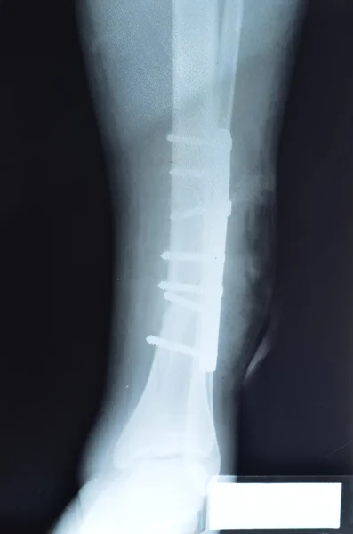 X-ray of feet with screws — Stock Photo, Image