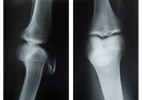 Rentgen kolena čepice ve dvou polohách — Stock fotografie