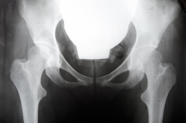 X-ray of the pelvis, displacement of the bones