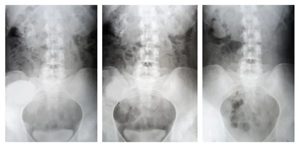 Röntgen der Hüften des Körpers, Analyse von Nierenerkrankungen lizenzfreie Stockfotos