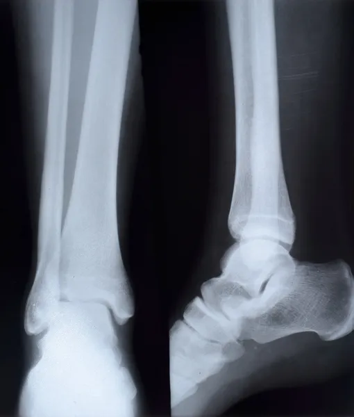 Raggi X della caviglia in due profili, segni di frattura nella perone — Foto Stock