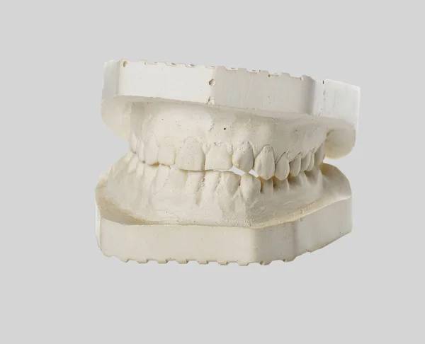 Plaster model of the jaw — Stock Photo, Image