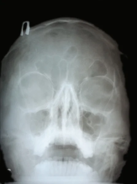 Broken nose, X-ray — Stock Photo, Image