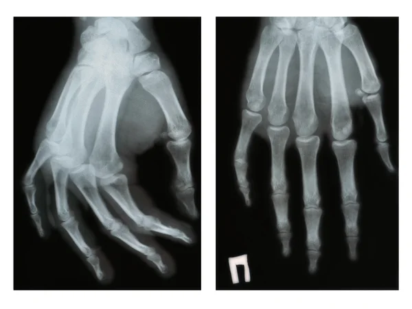 Vrickat fingret, två prognoser, röntgen — Stockfoto