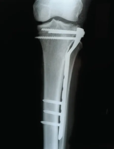 Śruby i płyty do łączenia złamania kości piszczelowej, x-ray — Zdjęcie stockowe