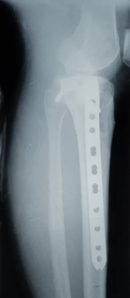 Śruby i płyty do łączenia złamania kości piszczelowej, x-ray — Zdjęcie stockowe
