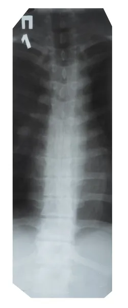 X-ray of the spine — Stock Photo, Image