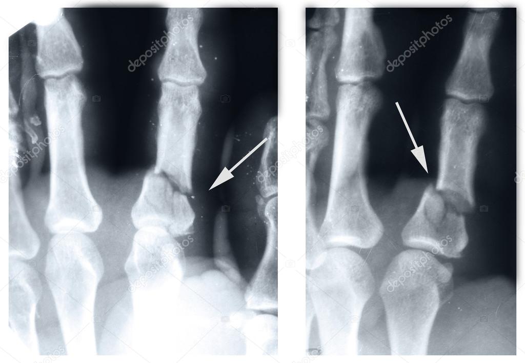 Boxer fracture