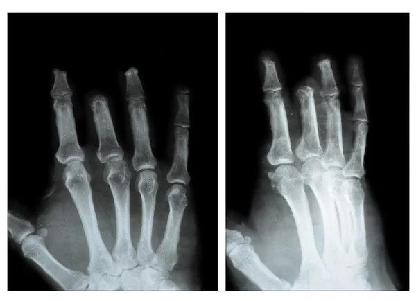 Hand, X-ray — Stock Photo, Image