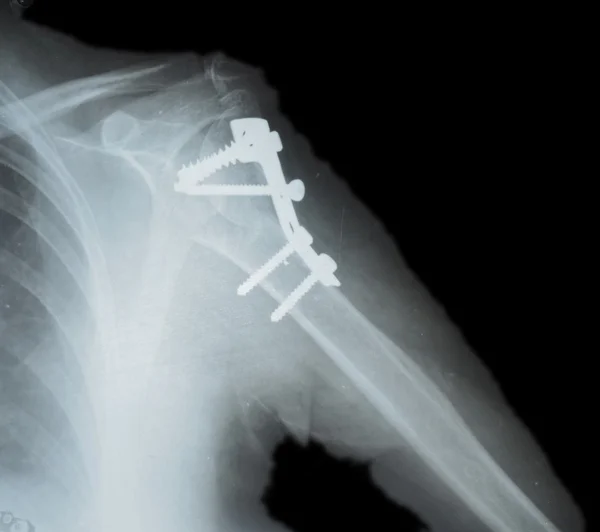 Верхней части плечевой кости — Stok fotoğraf
