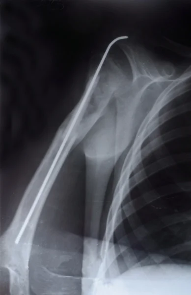 Верхней части плечевой кости — Zdjęcie stockowe