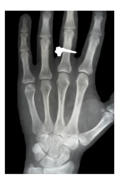 Yerinden parmak, x-ışını — Stok fotoğraf