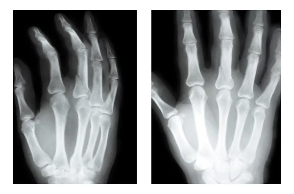 Boxer fracture, X-ray — Stock Photo, Image