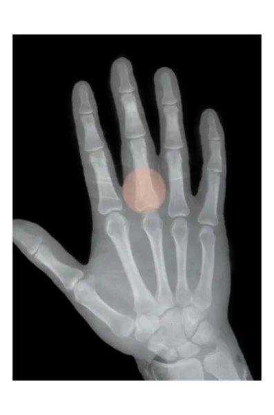 Boxer fracture, X-ray — Stock Photo, Image