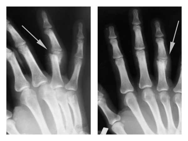 Hand, X-ray — Stock Photo, Image