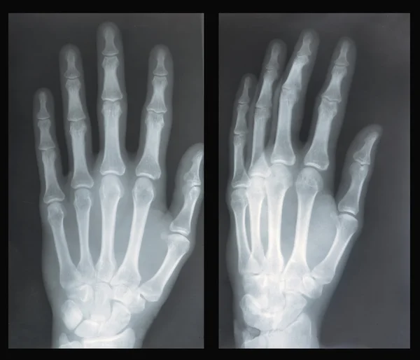Hand, röntgen — Stockfoto
