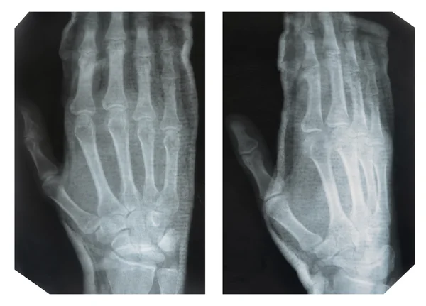 Hand, X-ray — Stock Photo, Image