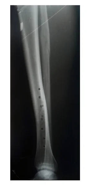 Leg fracture with displacement, X-ray — Stock Photo, Image