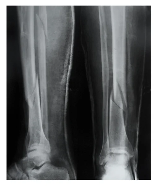 Fratura da perna com deslocamento, raio-X — Fotografia de Stock
