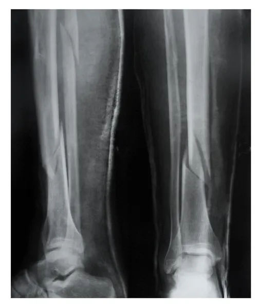 Leg fracture with displacement, X-ray — Stock Photo, Image