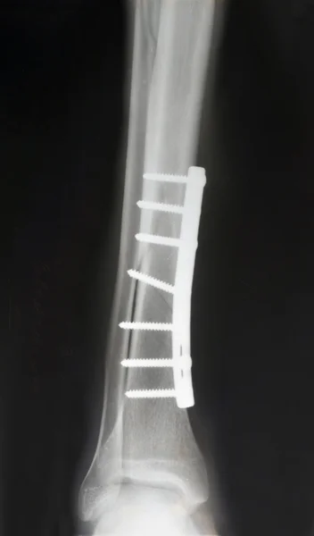 Leg fracture with displacement, X-ray — Stock Photo, Image