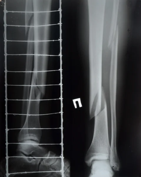 Leg fracture with displacement, X-ray — Stock Photo, Image