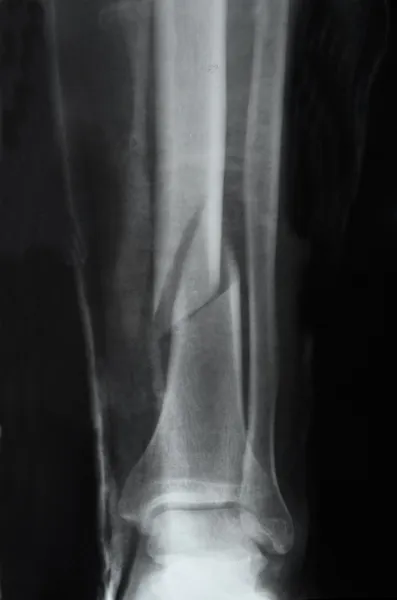 Leg fracture with displacement, X-ray — Stock Photo, Image