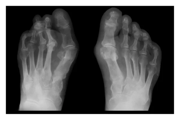 Смещение костей, рентген — стоковое фото