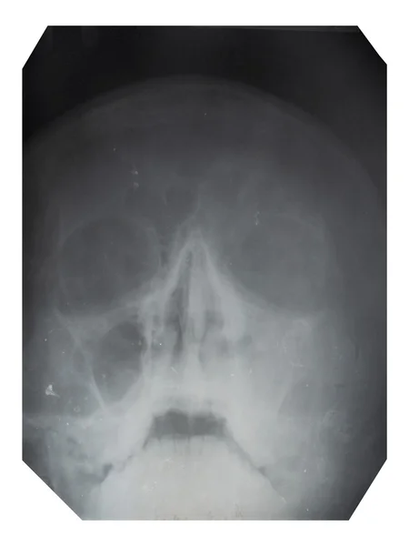 鼻子骨折、 x 射线 — 图库照片