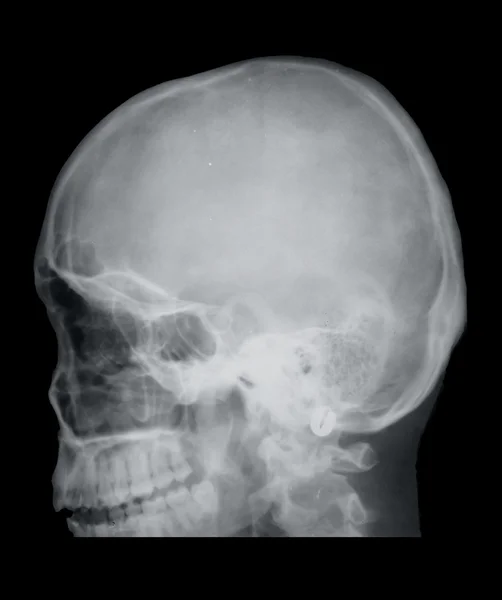 Fratura do nariz, raio-X — Fotografia de Stock