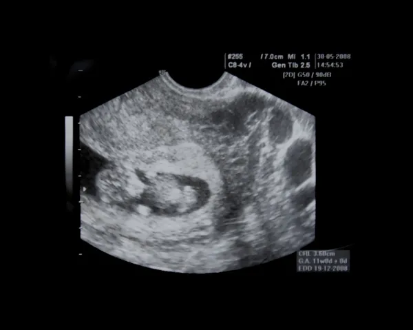 Bebé dentro del vientre de su madre —  Fotos de Stock