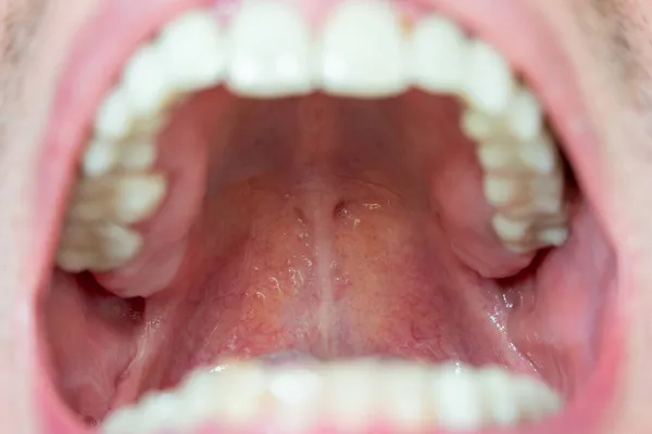 Back Throat Roof Mouth Macro Close View Caucasian Male Pharynx — Stock Photo, Image