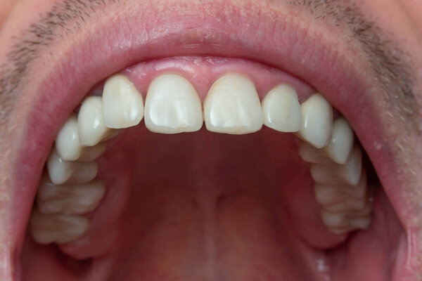 Caucasian male opened mouth close up macro shot. Row of with teeth, visible oral cavity, unrecognizable face.