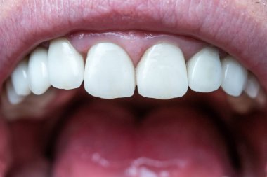 Caucasian male open mouth showing row of white teeth and back of the throat. Close up macro shot, unrecognizable face.