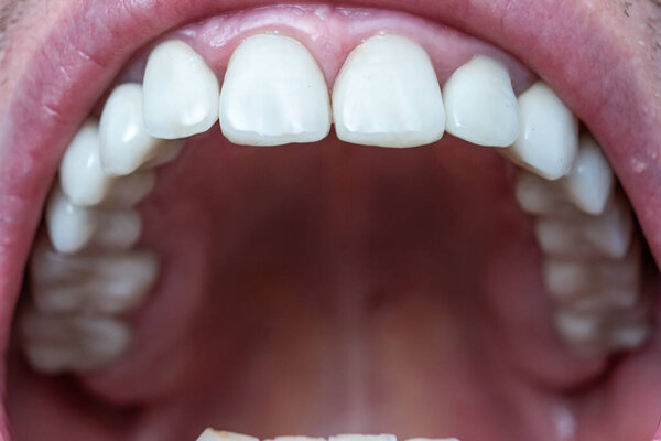 Caucasian male open mouth showing row of white teeth and back of the throat. Close up macro shot, unrecognizable face.