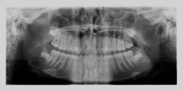 Radiografía dental — Foto de Stock