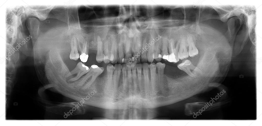 panoramic dental X-Ray