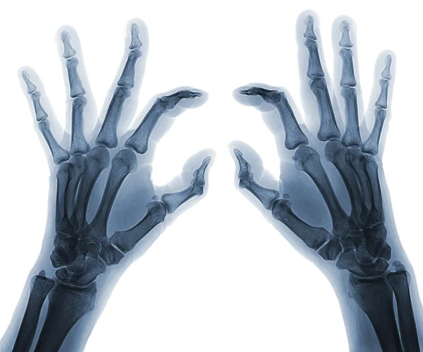 Mãos de raio-X — Fotografia de Stock