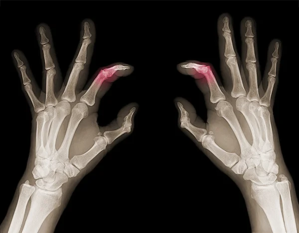 X-ray van handen — Stockfoto