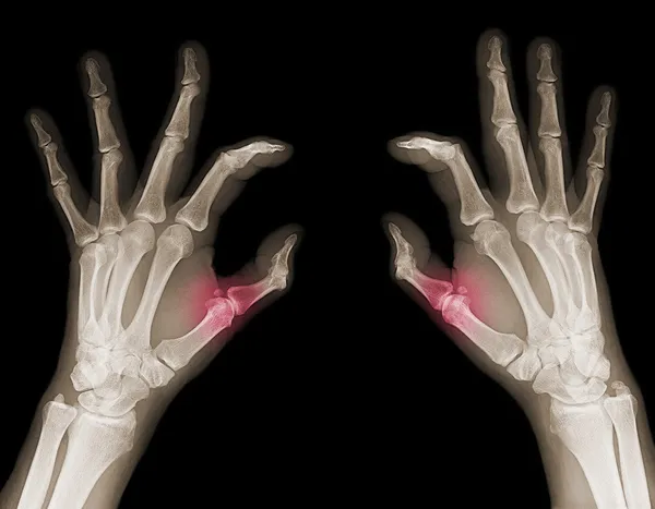 X-ray of hands — Stock Photo, Image